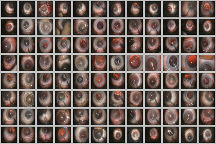 Cataract case analysis visualization showing detailed eye examinations